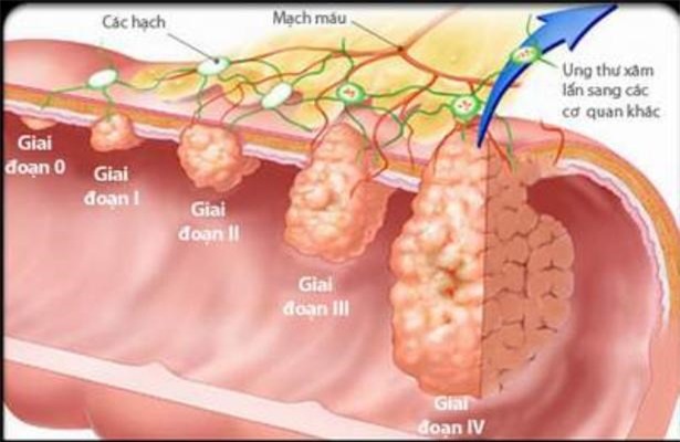 
Hình ảnh giai đoạn của ung thư đại trực tràng
