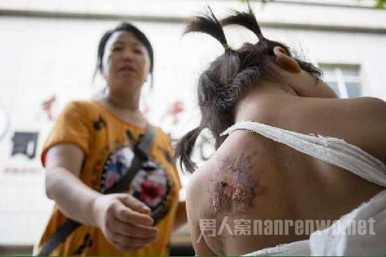 
Nước n&oacute;ng khiến cho phần da ph&iacute;a sau cơ thể b&eacute; hầu như đều bị bỏng rộp l&ecirc;n (ảnh minh họa)
