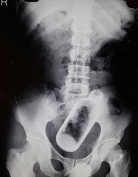 
Hình ảnh siêu âm cho thấy cả một chai thủy tinh trong bụng người đàn ông 36 tuổi.
