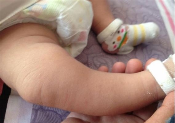 Nhiều người có quan niệm mua giày dép rộng một chút, con đi sẽ được lâu dài hơn mà không biết rằng nó ảnh hưởng đến chân của trẻ.