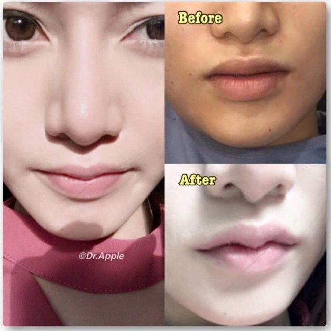 Nhiều cô gái mạnh tay chi tiền để sở hữu đôi môi sừng trâu.