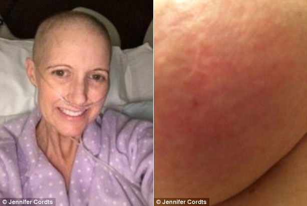
Jennifer Cordts, 46 tuổi, bị sốc nặng khi phát hiện ra đốm phát ban ở một bên ngực của mình thực ra là bệnh ung thư vú thể viêm giai đoạn cuối.

