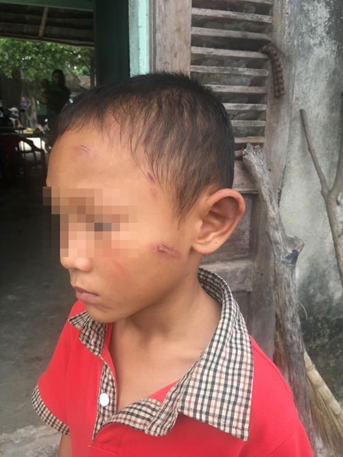 Cháu T thường xuyên bị dì ruột đánh đập
