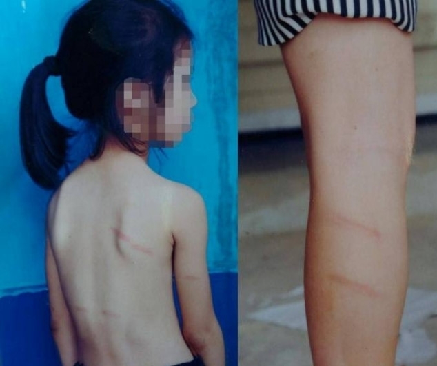 Nhiều vết bầm tím xuất hiện trên chân và phía sau lưng cháu Hoa. Ảnh: N.A.
