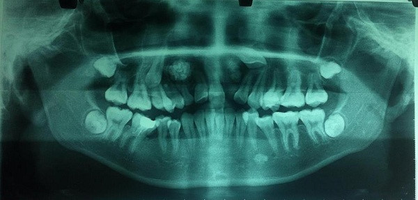 Phim panaroma toàn cảnh răng của bệnh nhân, cho thấy u răng, răng ngầm tương ứng bên phải và bên trái trên phim.