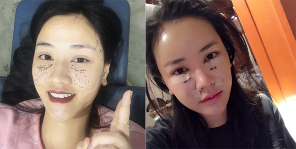
Maya khoe ảnh trước và sau khi sửa mặt.
