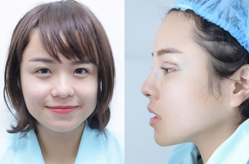 
Giọng ca 25 tuổi thừa nhận cô vừa thực hiện phẫu thuật thẩm mỹ mũi và mắt. Ảnh: NVCC.
