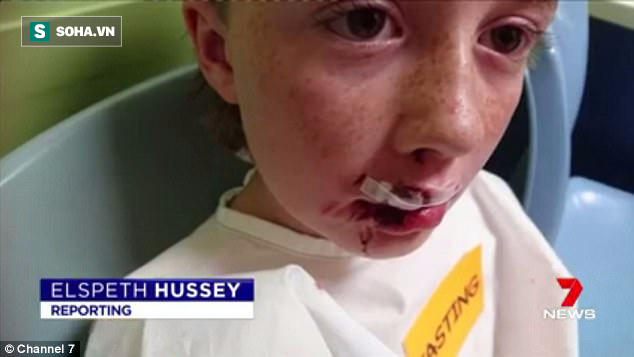 
Sau cuộc tấn công, cậu bé Matty đã bị thương nặng ở môi.
