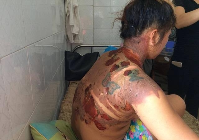 Chị Vui bị bỏng nặng vì bị chồng tưới nước sôi vào người