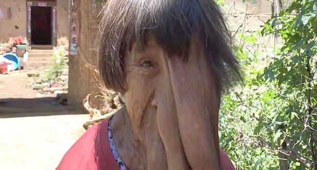 
Người phụ nữ khốn khổ có khuôn mặt chảy xệ làm mọi nguời liên tưởng đến loài voi
