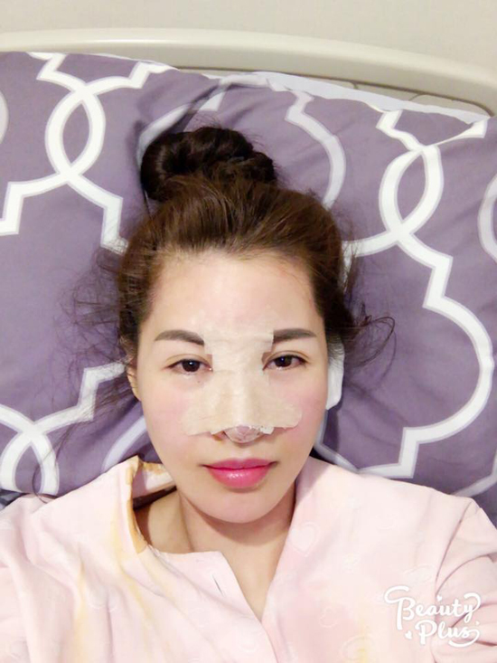
Tối 10/7, trên facebook cá nhân, ca sĩ Quế Vân khiến mọi người ngạc nhiên khi lại khoe ảnh vừa phẫu thuật thẩm mỹ, dù mới cách đây 3 tháng cô vừa phẫu thuật toàn bộ khuôn mặt.
