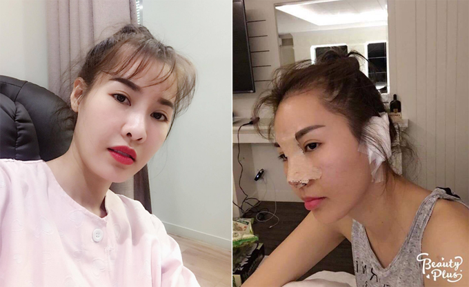 Đây là lần thứ 2 Quế Vân sang Hàn Quốc phẫu thuật thẩm mỹ chỉ trong vòng 3 tháng vì chưa thực sự hài lòng với nhan sắc sau cuộc dao kéo hồi tháng 4/2017.