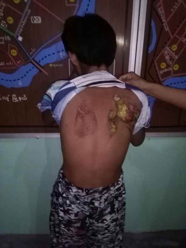 
Phần lưng của c&ocirc; b&eacute; bị nh&agrave; chủ d&ugrave;ng b&agrave;n l&agrave; n&oacute;ng ấn l&ecirc;n.
