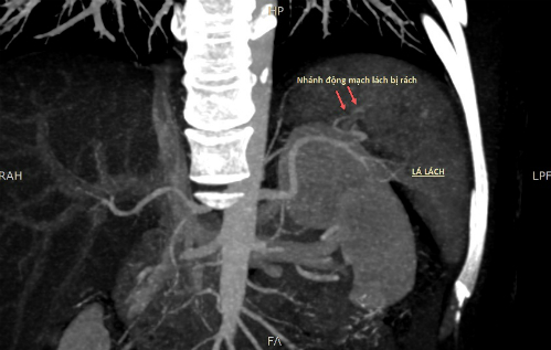 Hình ảnh nhánh động mạch lách bị rách.