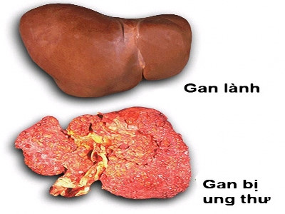 
Điểm khác nhau giữa gan lành và gan bị ung thư.
