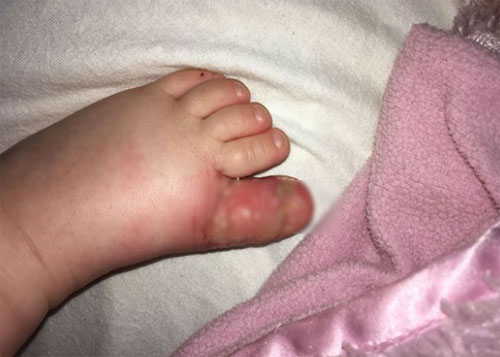 
Ngón chân cái của Aria bị sưng tấy, chảy mủ. Ảnh: Mercury Press Media.
