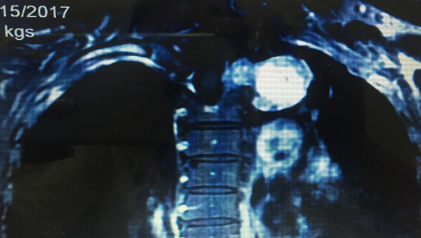 
Hình ảnh khối u phình to trong tuỷ sống, chèn ép vào lồng ngực
