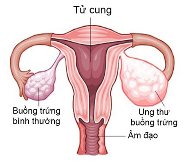 
Sự khác nhau giữa buồng trứng bình thường và buồng trứng bị ung thư.
