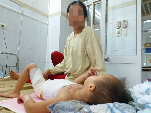 Đa số trẻ bị bỏng do sự bất cẩn của người lớn.