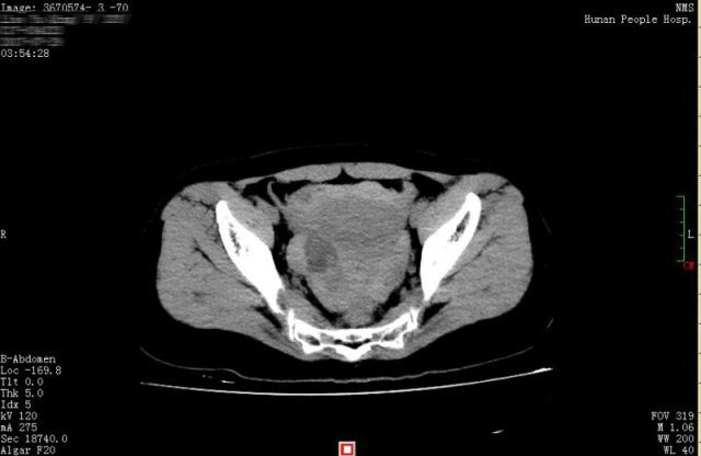 Bản chụp CT phát hiện ra rằng Hiểu Khánh có một lượng máu lớn và chất lỏng trong ổ bụng và vùng chậu. Ảnh: Xiaoxiang Morning Post.