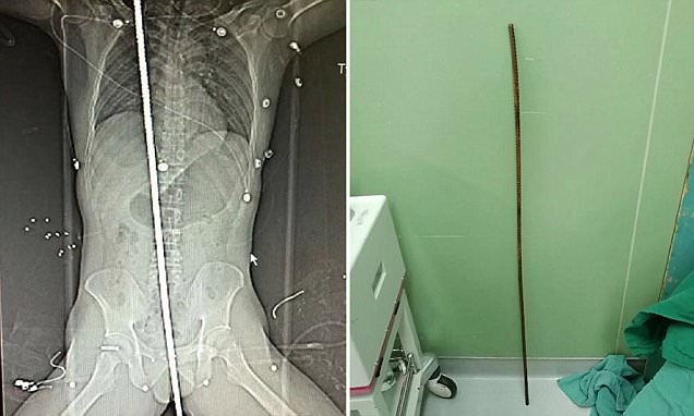 
Ảnh chụp X-quang về người công nhân trong tai nạn (trái) và thanh kim loại đã đâm xuyên người anh ta.
