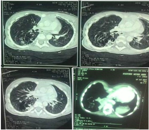 Phim CT scan ngực ghi nhận tổn thương phổi biệt trí trong thùy dưới phổi phải của bệnh nhi.