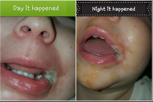 Vết bỏng trên miệng của bé gái 19 tháng tuổi trong ngày xảy ra vụ việc