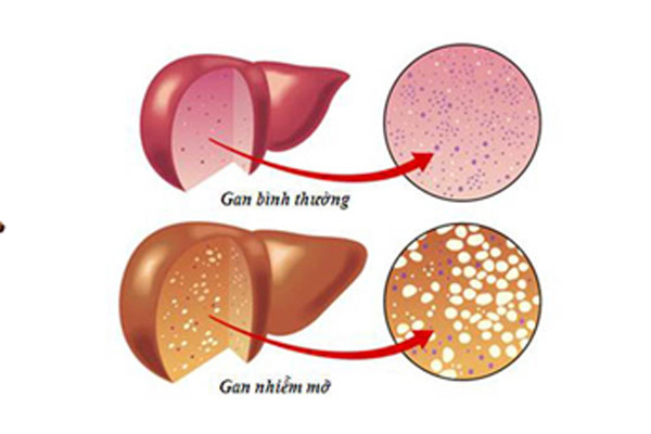 
Gan nhiễm mỡ khi chất béo trong gan vượt quá 5%. Ảnh: alwaysayurveda.net
