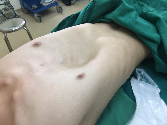 Hố ngực lõm của chàng trai trước phẫu thuật.