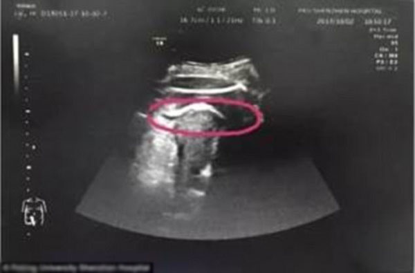 
Hình ảnh siêu âm cho thấy vết rách tử cung trong bụng Zhang.
