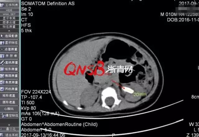 Kết quả chụp CT sỏi thận của Tiểu Ái.