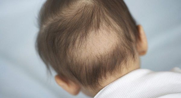 Rụng tóc nhiều ở nam tuổi dậy thì  Trẻ có thể bị hói đầu sớm