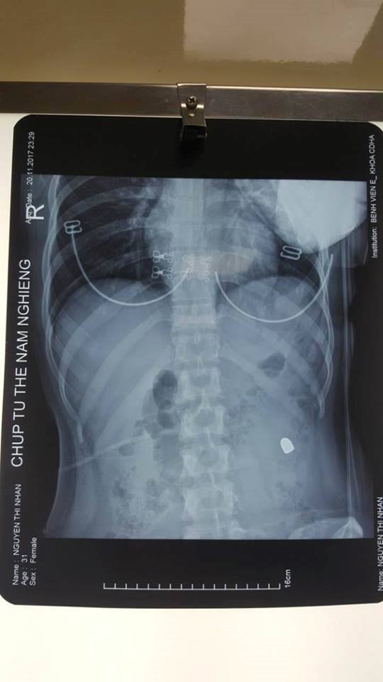 Hình ảnh viên đạn trong vùng bụng bệnh nhân. Ảnh: T.X.