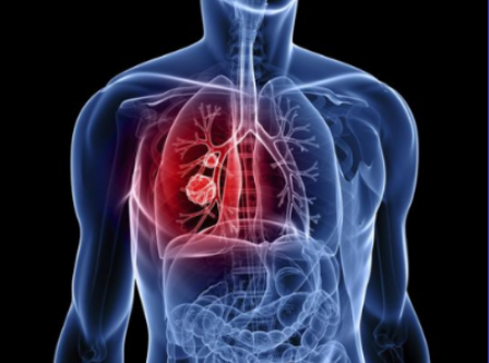 Ung thư phổi là 1 trong 5 căn bệnh ung thư thường gặp nhất tại Việt Nam