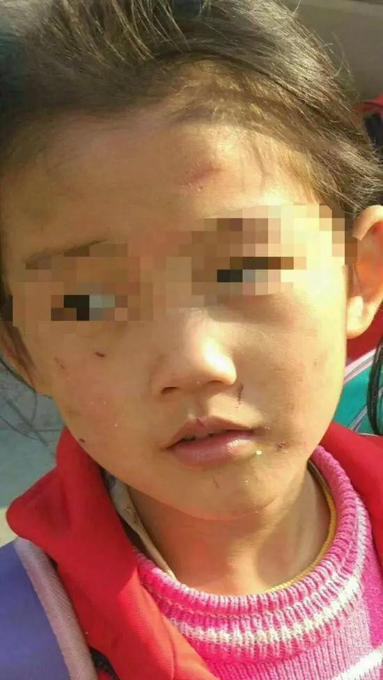 Trên khuôn mặt của bé gái 6 tuổi này thường xuyên có nhiều vết xước, bầm tím.