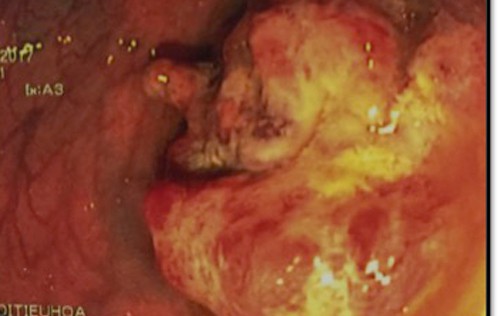 Hình ảnh khối u đại tràng của bệnh nhân