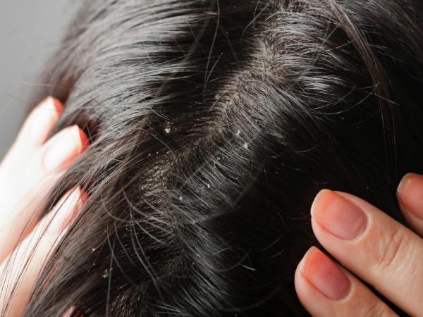 Tóc/Da dầu: Ngứa ngáy trên đầu không phải chỉ do gàu gây ra mà còn có thể là do vi khuẩn kết hợp với bụi bẩn trên đầu.