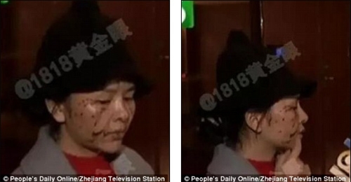 
Gương mặt biến dạng và nhiều vết thương của Tian.
