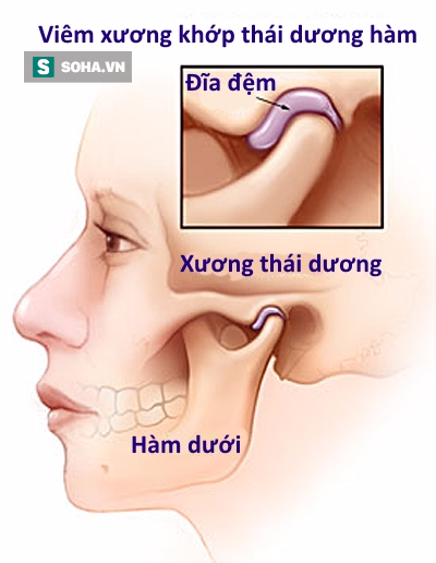 
Do đặc trưng về vị trí, khớp thái dương hàm cũng là một trong những bộ phận dễ dàng bị ảnh hưởng do thói quen nhai lệch. (Tranh minh họa).
