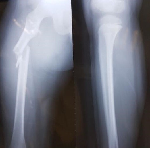 Hình ảnh khi xương đùi của học sinh Trần Chí Kiên được chụp X-quang. Ảnh: NVCC.