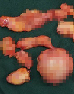 Hàng chục khối u từ silicon lỏng được lấy ra từ ngực bệnh nhân.