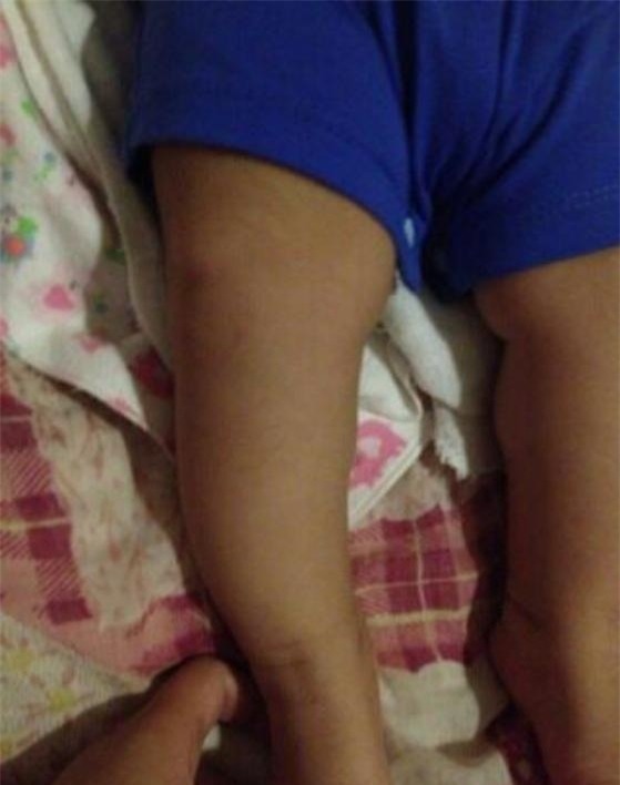 Thấy con có những bước đi khập khiếng, mẹ trẻ mới vội vàng đưa con đi khám.