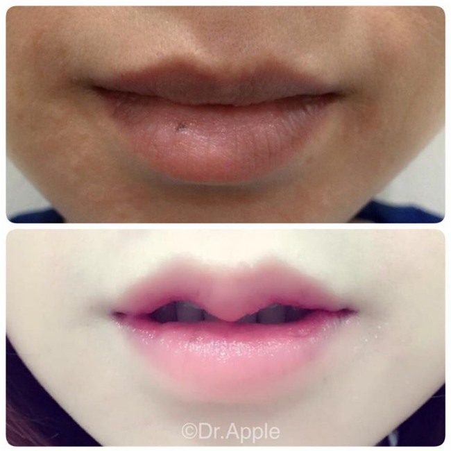 Việc cắt bớt môi sẽ để lại nhiều biến chứng.