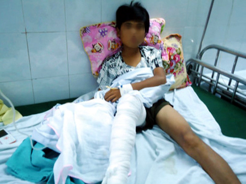 Em Mai Văn Ch. đang được điều trị tại Bệnh viện Bỏng quốc gia