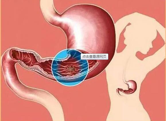 
Rất nhiều bệnh ung thư đường ruột là do các polyp (bướu thịt) tiến triển, đặc biệt là polyp kết tràng.
