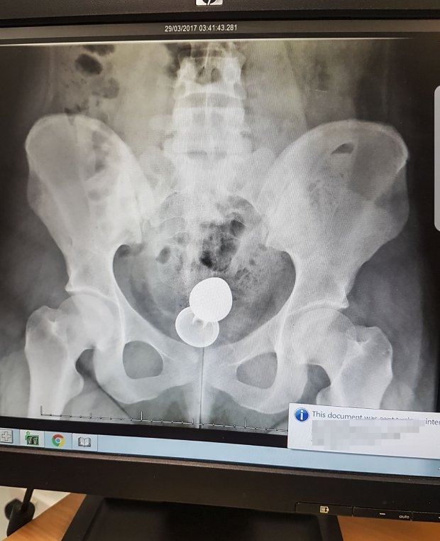 
Kết quả chụp X-quang cho thấy món đồ chơi tình dục đã bị đẩy lên rất cao trong ruột của Emily.

