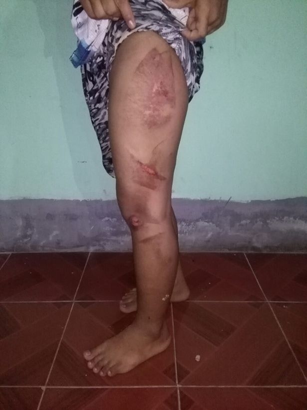 
Vết thương ở v&ugrave;ng đ&ugrave;i của b&eacute; g&aacute;i.
