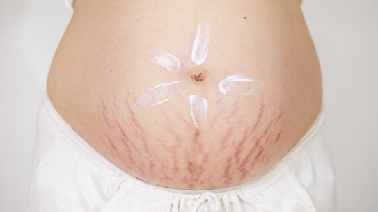 Rạn da thường xuất hiện khi mang thai
