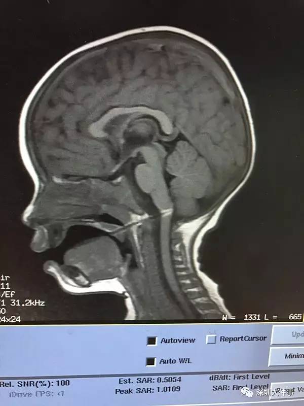 
Hình chụp X-quang thấy được cây xiên que đã đâm vào hành não của cậu bé. (Ảnh: Sohu)
