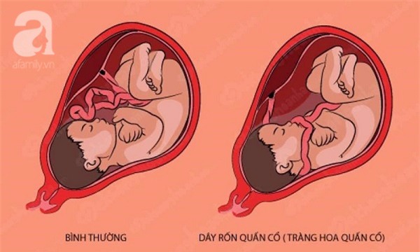 
Dây rốn (tràng hoa) quấn cổ là 1 hiện tượng bình thường.
